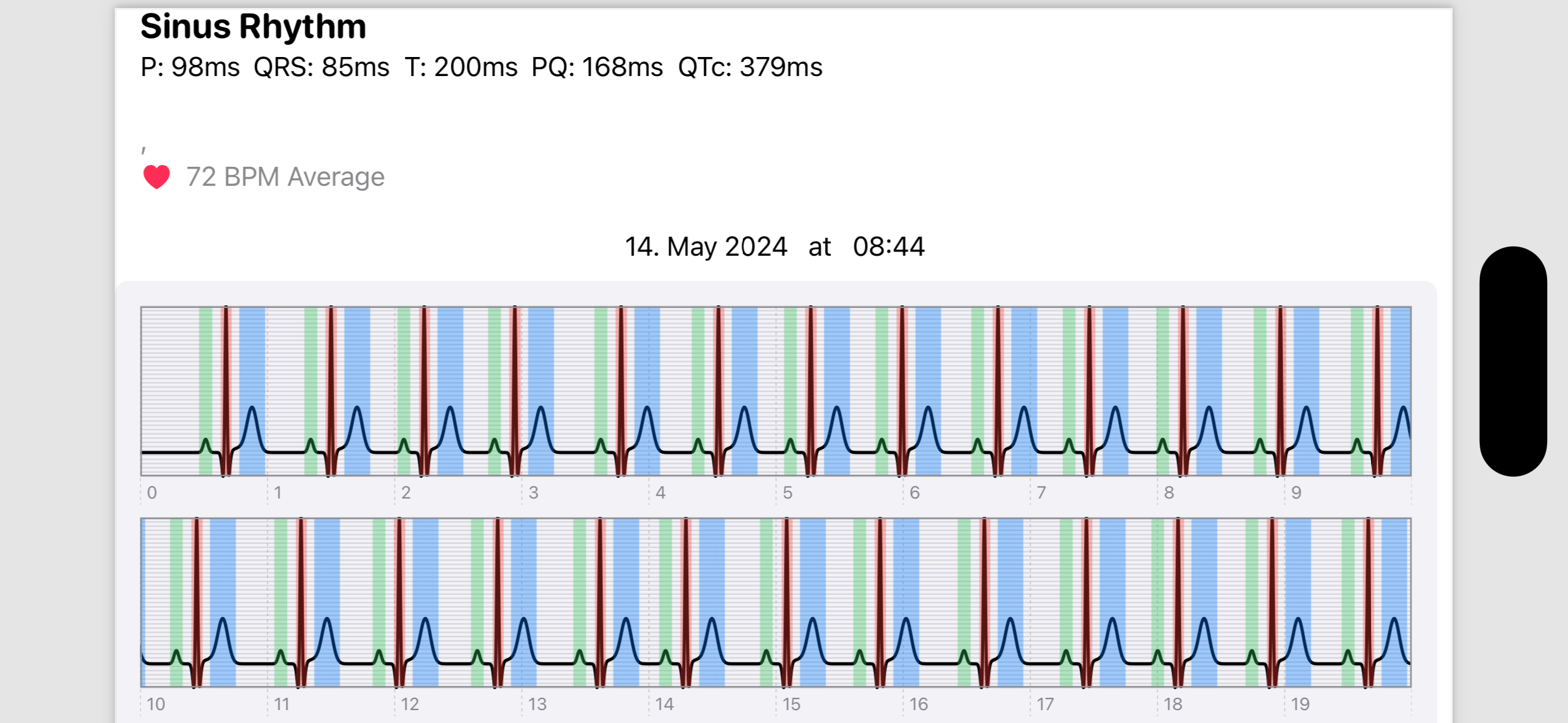 ECG AI App - PDF Export Feature for Sharing ECG Reports